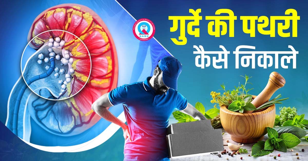 गुर्दे की पथरी कैसे निकाले